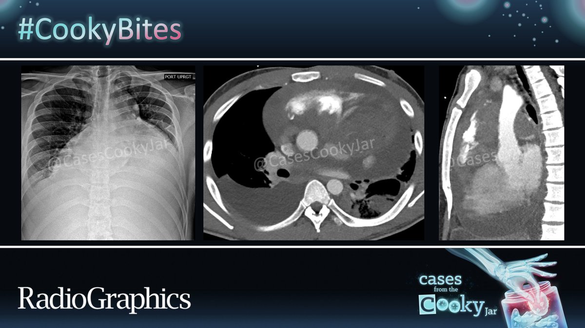 25-year-old man with shortness of breath. What is the diagnosis❓ We’ll post the answer in 24h. Share companion cases with us using #CookyBites #152. We will RT the best cases! #RGphx @cookyscan1 @RadioGraphics
