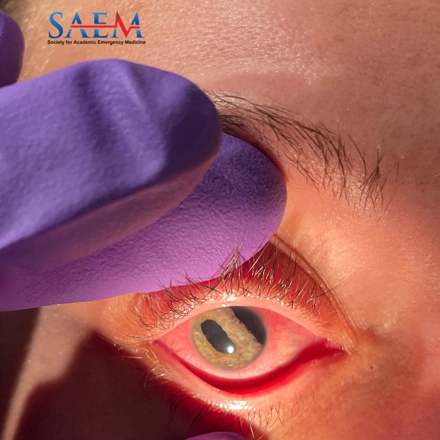 SAEM Clinical Images Series: Two Pupils for the Price of One What's going on in this case of 'double pupil?' aliem.com/saem-clinical-… @SAEMonline