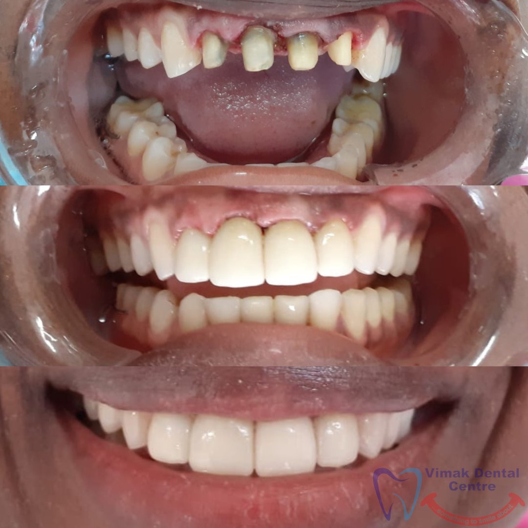 Acquire a fully restored and transformed smile with dental crowning. Book an appointment Now: 0714481158.
vimakdentalcentre.co.ke
#vimakdentalcentre
#vimakdentalservices
#vimakdentalcrowns