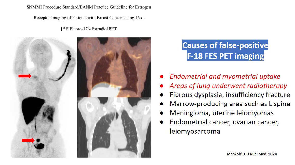 The recent SNMMI/ EANM Guideline for estrogen receptor imaging mentioned causes of false-positive FES PET such as physiologic uptake at uterus, ovary, and pituitary gland, post-RT lung fibrosis, etc. For more details: jnm.snmjournals.org/content/65/2/2… #breastcancer