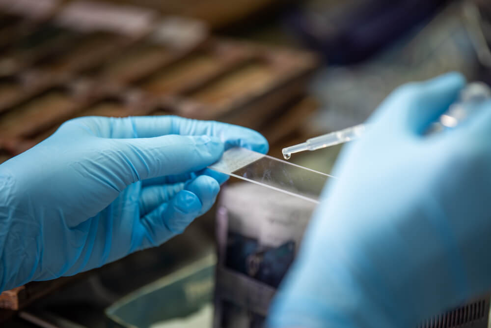 JObstetrics's tweet image. A procedure in which a small brush is used to gently remove cells from the surface of the cervix and the area around it so they can be checked under a microscope for cervical cancer or cell changes that may lead to cervical cancer.
#paptest #hpv #papillomavirus #infections