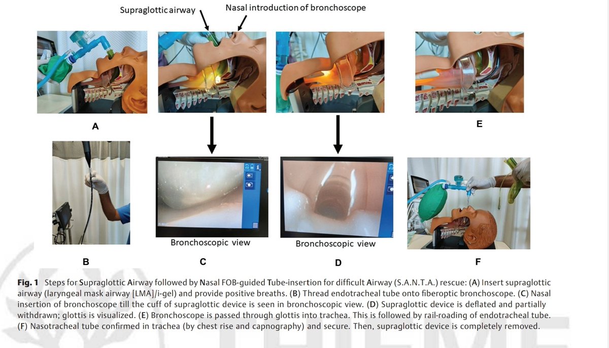 Maninder_picu's tweet photo. Impossible walls, force creation of new solutions. The innovation of S.A.N.T.A technique for difficult intubation in infants got recently published in Journal of Ped Intensive Care. #dastrainees
#pedsicu #anesthesia #pulmonology #WFPICCS https://t.co/OMcywiVc5i https://t.co/33a1ddDD8c