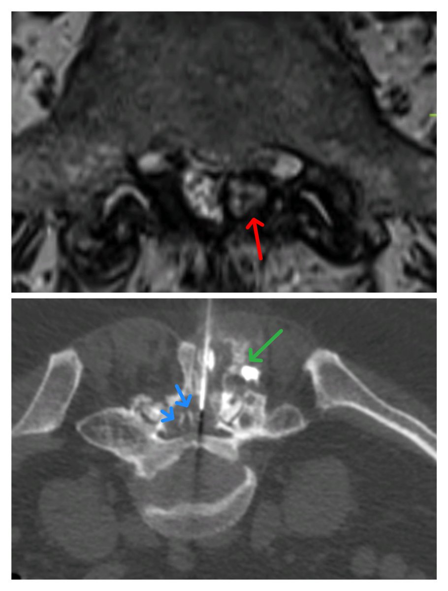 Pop that cyst! 69yr old patient with severe left radicular pain and back pain. Previous left S1 nerve block at another center with no relief of symptoms. MRI reviewed: showed bilateral severe facet arthropathy at L5-S1 with left synovial cyst (red arrow) causing cauda equina…