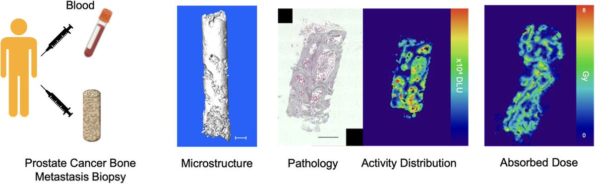 JournalofNucMed's tweet image. Highly nonuniform distribution and absorbed dose of ²²³Ra present opportunities and challenges to improved outcomes for patients receiving α-radiopharmaceutical therapy. ow.ly/ANyR50QyqEK 

#RPTherapy #NuclearMedicine #ProstateCancer