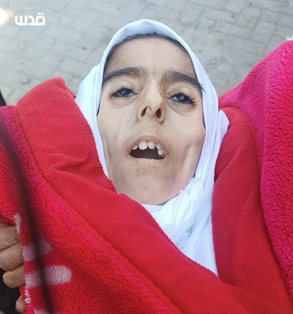 DrJamal11's tweet photo. إلهام جحا (17 عاما) تموت جوعا حتى الموت في شمال غزة:
شاحنات المساعدات المتكدسة في رفح لا تذهب إلى أي مكان، 
لاتزال اسرائيل تمارس المجاعة للموت المدنيين غزة
إنه عمل إجرامي من أعمال اسرئيل
 #AirDropAidForGaza

#ابو_عبيدة #ابوعبيده #إسرائيل_إرهابية #الاباده_الجماعيه #القبة_الحديدية #اليمن #جنوب_افريقيا #جنود_الاحتلال #حرب_غزة #حلل_يا_دويري #خان_يونس #خانيونس #طوفان_الاقصى #غزة #غزة_الآن #غزة_العزة #غزة_تستغيث #غزة_تنتصر #غزه_تقاوم #غزه_مقبرة_الدبابات #فلسطين #فلسطين_الان #فلسطين_حرة #فلسطين_قضيتنا #كتائب_القسام #ولعت #رفح_تحت_القصف
#FreePalestine #Gaza #Gazabombing #Hamas #IsraeliNewNazism #Isreal_is_ISIS #IsrealiTerrorist #IsrealiWarCrimes #PalestineGenocide #Netanyahu_A_criminal_of_war #IsraelGazaWar #HumanRights #Palestine #AlJazeera #GazaHospital #CNN #BBC #IsraelTerrorism #CeaseFireInGaza #TerroristIsraeliForce #EthnicCleansingOfPalestine #GazaHolocaust