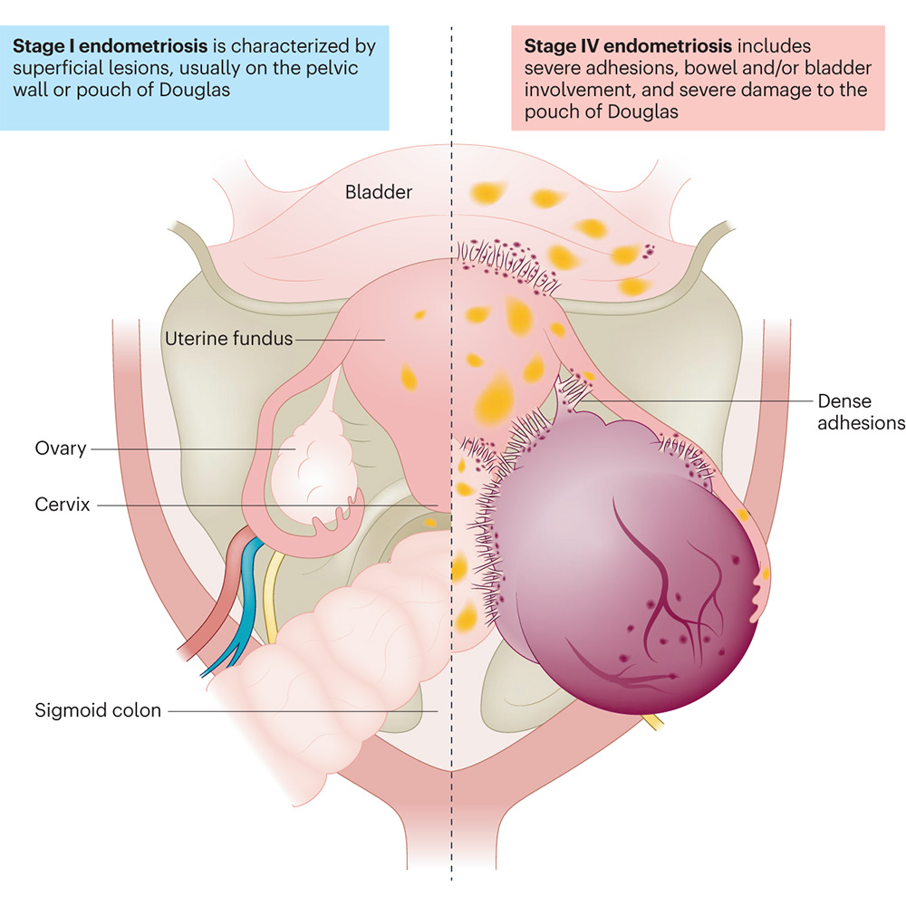 Advances in organoids and the role of the microbiome and diet are leading to new diagnostics and treatments for endometriosis, motivating a precision health approach to this long-neglected disease. Read the <a href="/NatureMedicine/">Nature Medicine</a> feature article. go.nature.com/3UHmMQ2