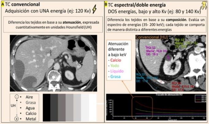 ¿Qué nos aporta la TC espectral en el abdomen y la pelvis? Traemos el #ArtículoRecomendadoDelLunes 🕵 ➡️ buff.ly/4a2m2d5 #FOAMrad #FOAMed @SERAM_RX @sediabdomen SERAM - Sociedad Española de Radiología Médica.