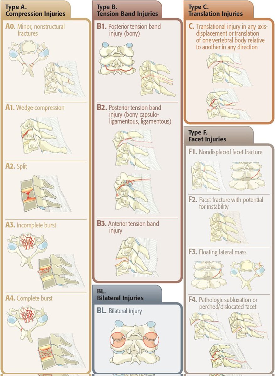 OBandarchi's tweet photo. 🔴The current AOSpine Trauma classification subdivides spinal column into 4 regions: upper C spine , subaxial C spine, thoracolumbar spine , &amp; sacral spine (S1-S5, including coccyx). 

Here➡️ Subaxial C spine.See also the comment 1 &amp; 2 &amp; 3 for other parts
https://t.co/382fmGpaMB https://t.co/Jd2c3xXYIo