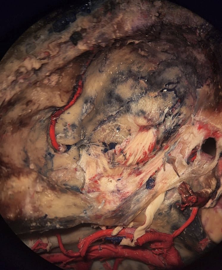 RAlmufarriji's tweet image. Middle fossa #labwork ©️