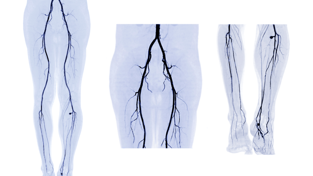 radcliffeVASCU's tweet image. 📚New #USCJournal Article: "Gender Disparities in PAD"

📚 Just Published!

🔓Access it here 👉 ow.ly/c4M1105jNb5

@CardioNerds #MedEd #CardioEd