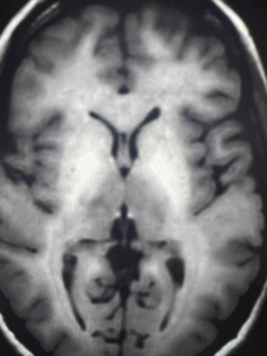 Tip of the day 💡: This is not a bad quality picture. This is a case of manganese deposition in the brain characterised by T1 shortening. Note the sparing however of the central pons and thalami. Trust me, it’s characteristic for Mn transporter defects.