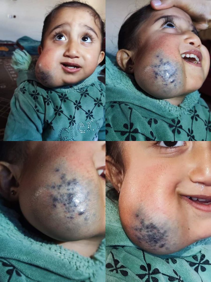 مناشدة لاصحاب القلوب الرحيمة، لمن لا زال يهمهم امرنا في غـ ـزة،

الطفلة اية ادهم سليمان كلاب، عمرها لا يتجاوز العامين، 

اية تعاني من ورم دموي كبير اسفل الخد الايمن، والورم يكبر تدريجيًا مع الوقت، اية تعاني من قلة النوم بسبب صعوبة في التنفس، +

#انقذوا_اية_كلاب