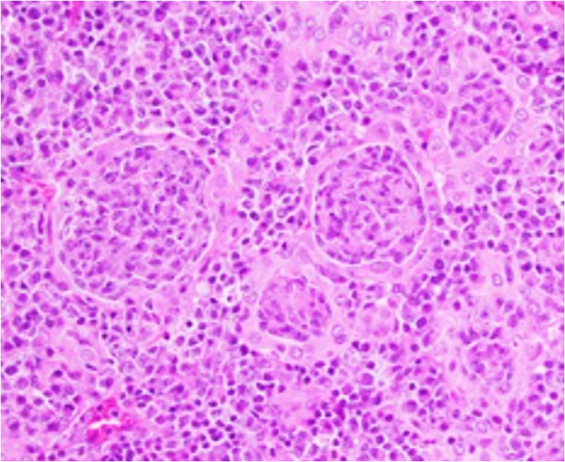 SibaElHussein's tweet image. Illustration of thyroid MALT lymphoma with “MALT ball”-type lymphoepithelial lesions, consisting of lymphoma cells surrounded by a ring of thyroid follicular epithelial cells #hemepath #lymsm #Surgpath #PathX #PathTwitter #MedEd #SoMe #CytoPath #Headandneckpath 

Picture from…