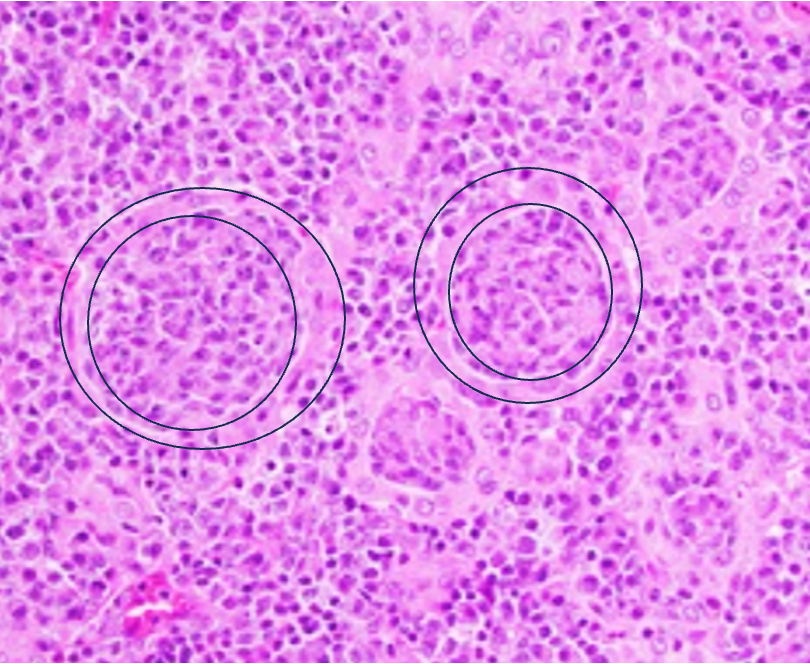 Illustration of thyroid MALT lymphoma with “MALT ball”-type lymphoepithelial lesions, consisting of lymphoma cells surrounded by a ring of thyroid follicular epithelial cells #hemepath #lymsm #Surgpath #PathX #PathTwitter #MedEd #SoMe #CytoPath #Headandneckpath 

Picture from