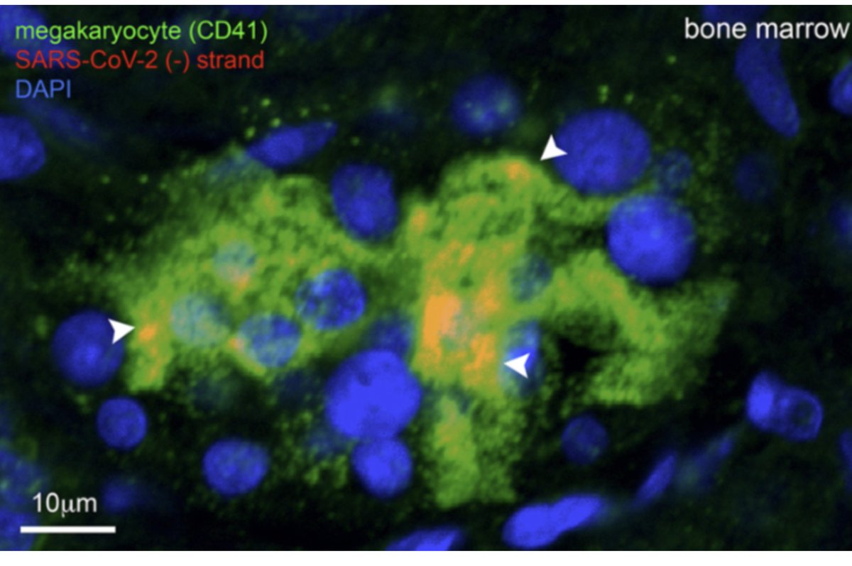 inkblue01's tweet image. SARS-CoV-2 in the bone marrow