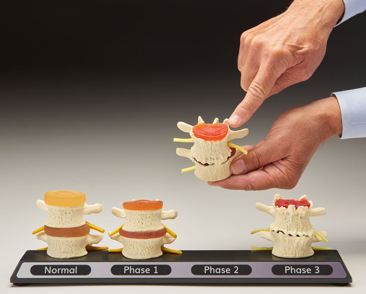ChiroOutfitters's tweet image. Lumbar Spine Models Bring Your Report of Findings to Life. chiropracticoutfitters.com/Spine-Degenera… #spinemodel