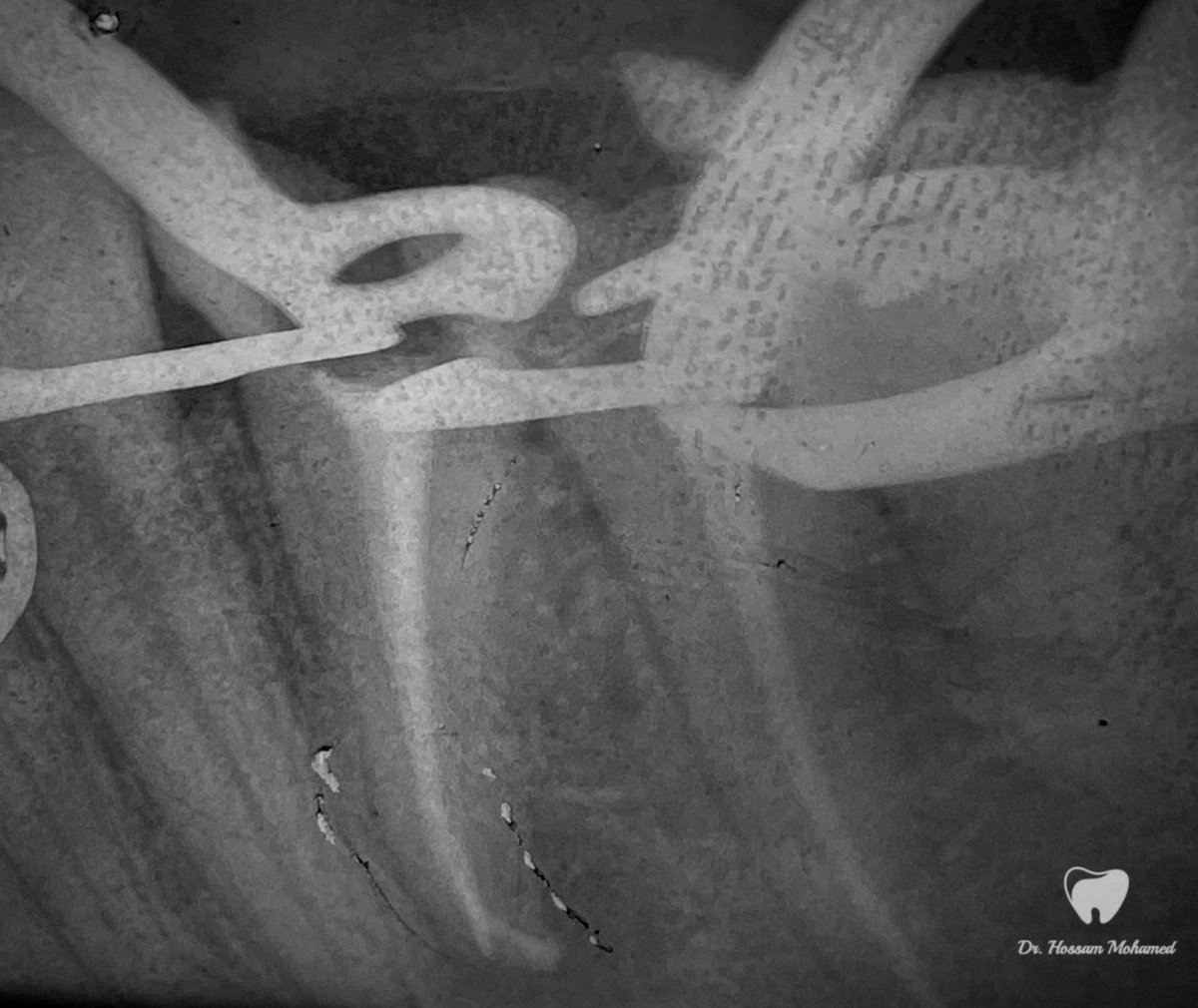 HossamMkhalaf's tweet photo. Story of retreatment of lower 4 and endo treatment of lower 5 🦷

الحمد لله ❤️ https://t.co/1tasf1fCW2