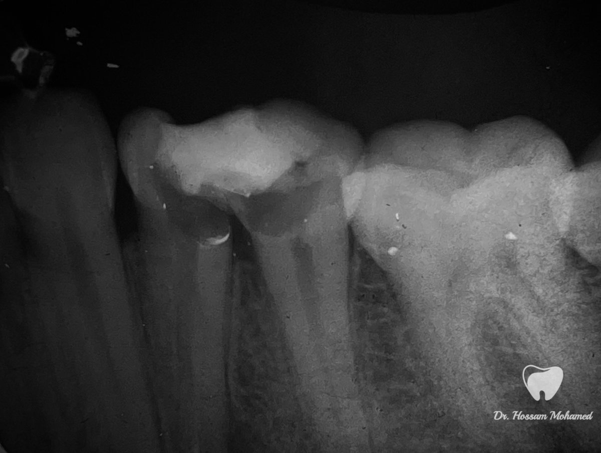 HossamMkhalaf's tweet photo. Story of retreatment of lower 4 and endo treatment of lower 5 🦷

الحمد لله ❤️ https://t.co/1tasf1fCW2