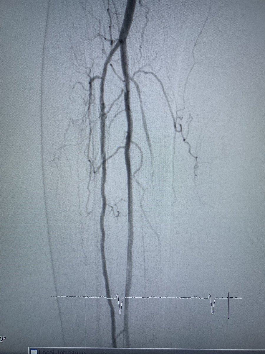 banderaldhafery's tweet image. #CLTI , 82y/o , DM
occlusion of ATA and PTA , heavy calcium and small arteries.
#revascularization ✅ of foot arch through ATA , limb saved from #amputation 

#endovascular 
#interventional 
#diabeticfoot