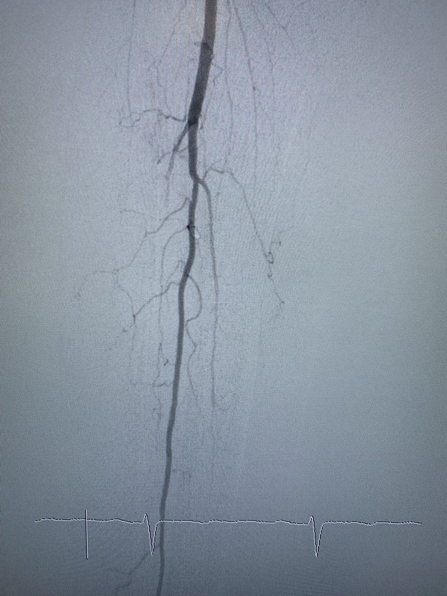 banderaldhafery's tweet image. #CLTI , 82y/o , DM
occlusion of ATA and PTA , heavy calcium and small arteries.
#revascularization ✅ of foot arch through ATA , limb saved from #amputation 

#endovascular 
#interventional 
#diabeticfoot
