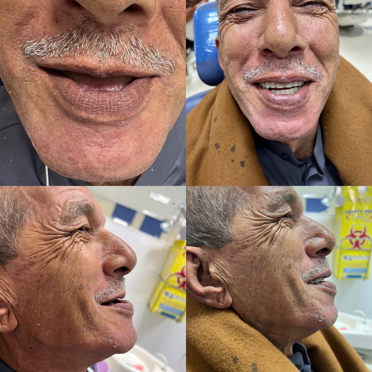 ziad_Ragab77's tweet photo. elhamdulla♥️😂
My first complete denture case.
Partner:@IlAhmedMagdylI ♥️♥️ https://t.co/aMqGolGOiy