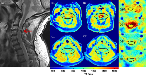 T1 signal on #spine #neuroimaging may correlate with #myelopathy outcomes and interventions #spinesurgery #neurology #neurosurgery #radres #neurorad #neurotwitter #orthotwitter #orthopedics #futureneurologist #futureneurosurgeon #neuromatch onlinelibrary.wiley.com/doi/10.1111/jo…