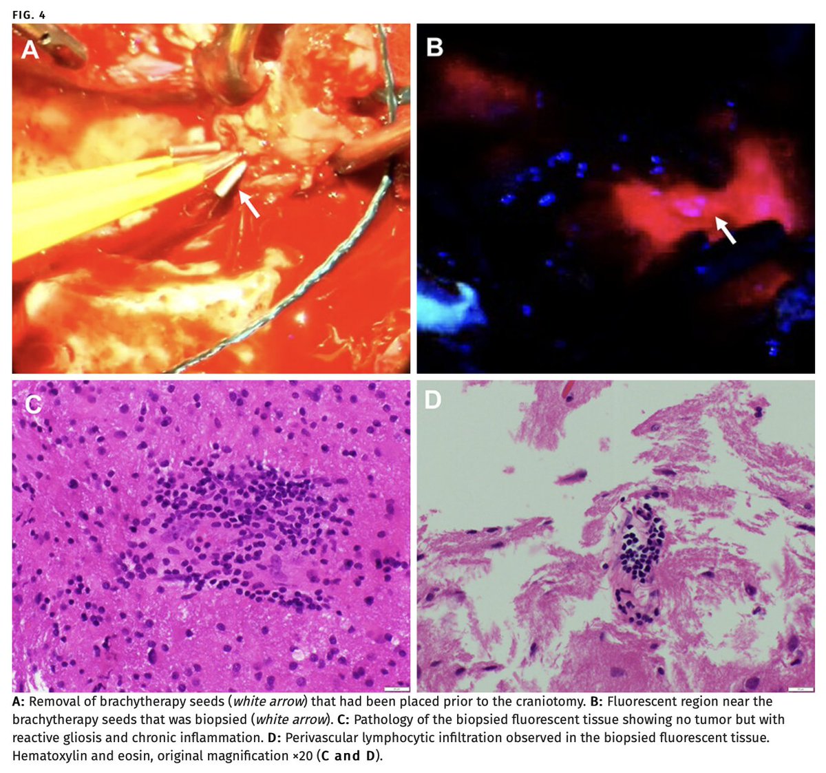 Excited to share our case report in @TheJNS on 5-ALA fluorescence in nonneoplastic tissue following brachytherapy, which was found during the resection of recurrent anaplastic meningioma and associated with immune cell infiltration.