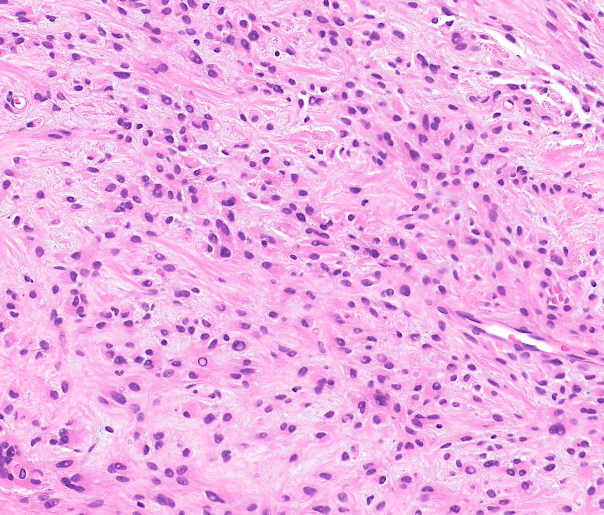 Greg_Charville's tweet photo. Now this is bone AND soft tissue pathology! #BSTpath https://t.co/Vor9jo0CCS