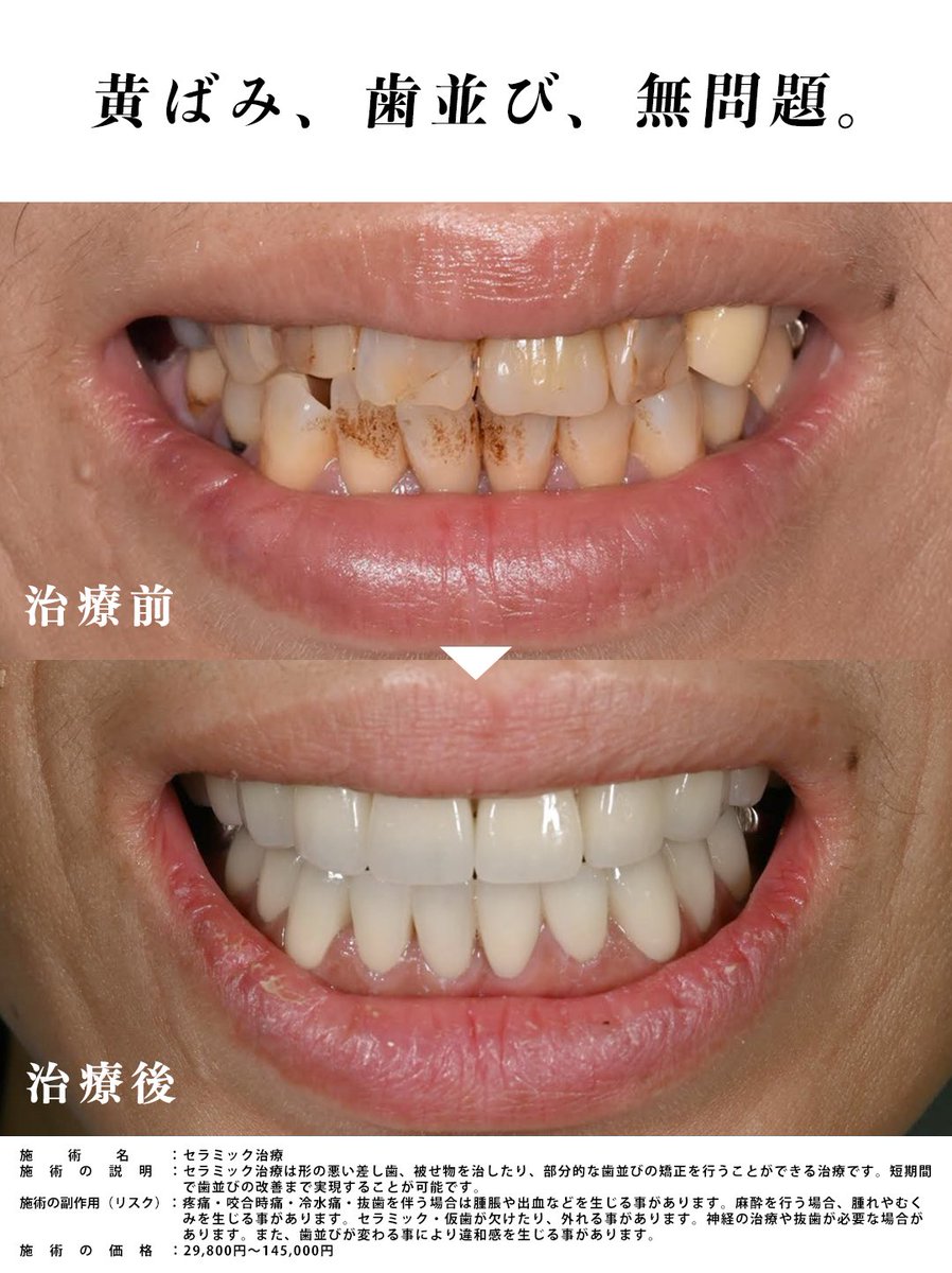 sbc_dental_jun's tweet photo. セラミック治療ならその黄ばみも歯並びともおさらばできます。
口元に自信を。

#セラミック治療
#下顔面美容
#下顔面 https://t.co/GBsRNtHAS7
