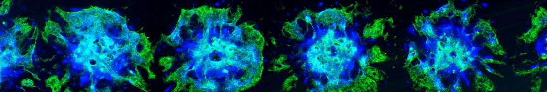 sulemanali's tweet photo. I've been blown away by the progress of medicine over the past decade

And one startup doing gene therapy really got my attention

You may be asking "What's gene therapy?"

Gene therapy uses genes to treat diseases

If you've got a genetic disease like Parkinson's, cancer, heart disease, etc., gene therapy can help in correcting it - straight Sci-fi shit

However gene therapy is a fairly recent field, but also fast-growing:
- until 2017 the FDA had approved 2 gene therapies
- in 2022 alone 3 therapies were approved

But that doesn't seem like that many. Why haven't we gotten 100's of gene therapies yet?

Because it can take years or even decades to find cures for certain diseases using traditional methods. And 90% of clinical trials fail, leading to wasted time and resources.

A company called Rosebud Biosciences is seeking to change that

@rosebudbiosci has developed an innovative approach for screening drugs and their effectiveness for children with rare diseases

Children account for 50% of all people with genetic diseases, and only 5% of genetic diseases have approved gene therapies. 

Rosebud is seeking to find solutions for the other 95%

And how they do this is mind-blowing

In their lab they use stem cells to grow 1000s of "micro-organs" (mini organs) that have the target gene mutations they want to treat

This allows for testing a large number of therapies across these organs and seeing which ones work, saving a ton of time and money, while also leading to better probability of getting through clinical trials

More gene therapies getting through clinical trials quickly = more diseases that can be treated

Gene therapy as a whole seems to be having a breakthrough moment and I'm excited to see how this space continues to grow!