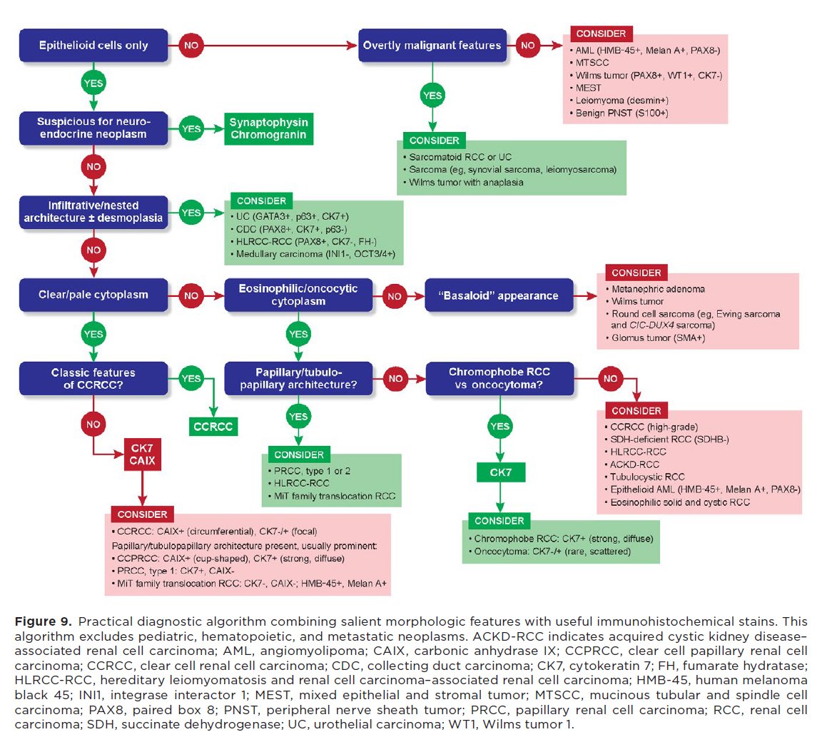 slusagar's tweet image. re-reading this🤘🏽paper by @HubertLauMD on renal mass biopsy

although current #GUpath #cytopath kidney tumor classification has updates, I still LOVE this flowchart &amp;amp; had to share

PMID: 30193011 
DOI: 10.1002/cncy.22037