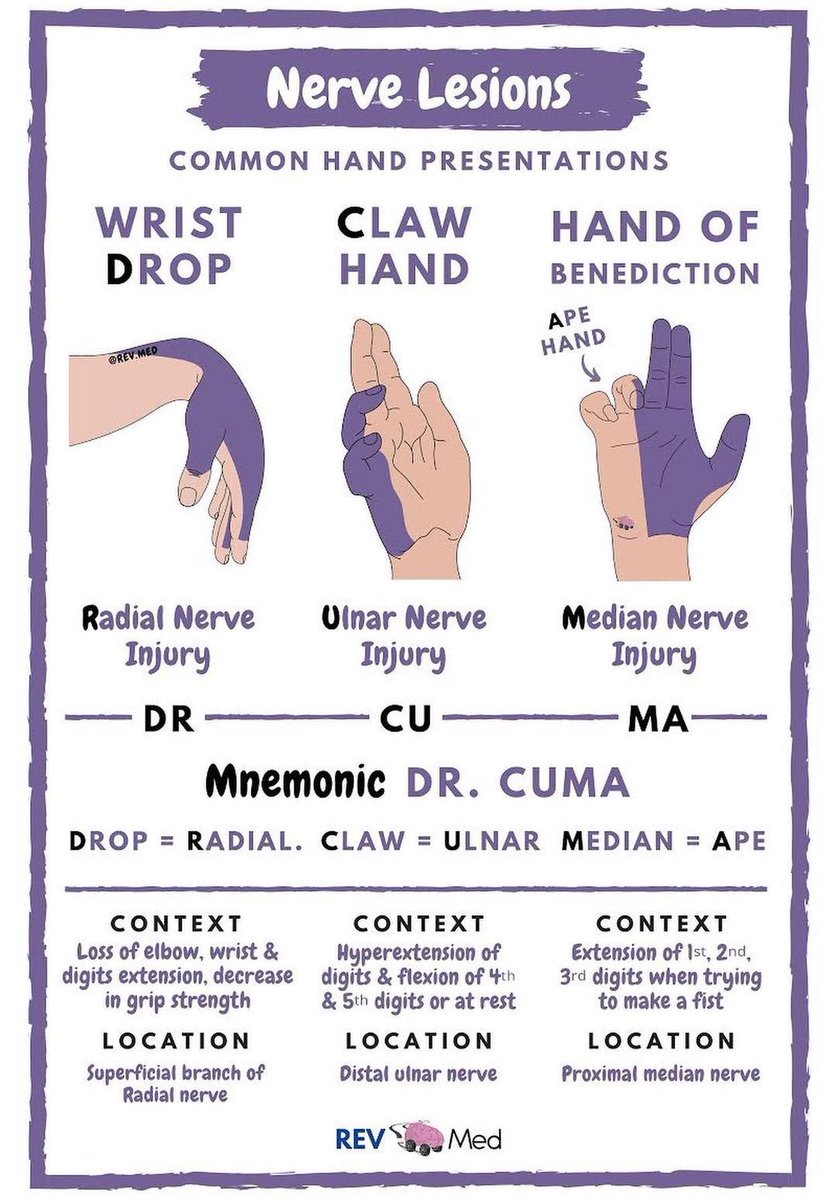 xloqpolx's tweet photo. @Naeem_ch111 Claw hand appearance indicate Ulnar injury ✅ https://t.co/7W4dnuNM92