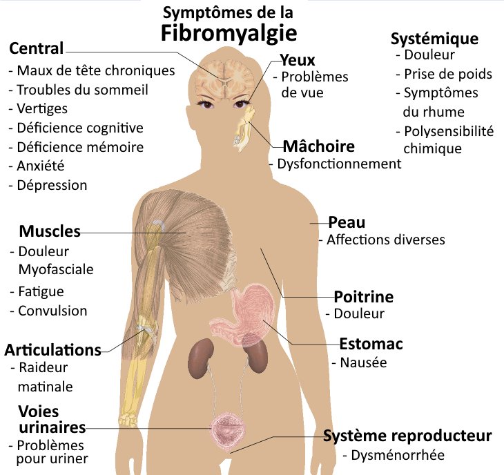 La fibromyalgie est un dérèglement du SRA caractérisé par des douleurs musculo-squelettiques (chroniques et généralisées), une fatigue, ainsi que des troubles du sommeil, gastro-intestinaux et psychologiques.

Doi: 10.1007/s11916-002-0050-5

#Fibromyalgie #Fibromyalgia
#sra