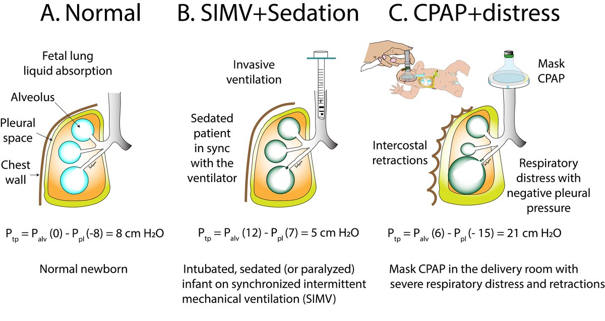 Satyan (@neosatyan) on Twitter photo Have you wondered why CPAP in a term infant with distress can increase risk of an air-leak? A review article on pneumothorax by colleagues <a href="/UCDavisChildren/">UCDavisChildrensHosp</a> in <a href="/JPerinatology/">Journal of Perinatology</a> with #neographics - free download at rdcu.be/dzDg5 <a href="/Evan_Giusto/">Evan Giusto</a> <a href="/dryogensingh/">Yogen Singh</a> Drs.Vali & Jhaveri Have you wondered why CPAP in a term infant with distress can increase risk of an air-leak? A review article on pneumothorax by colleagues <a href="/UCDavisChildren/">UCDavisChildrensHosp</a> in <a href="/JPerinatology/">Journal of Perinatology</a> with #neographics - free download at rdcu.be/dzDg5 <a href="/Evan_Giusto/">Evan Giusto</a> <a href="/dryogensingh/">Yogen Singh</a> Drs.Vali & Jhaveri
