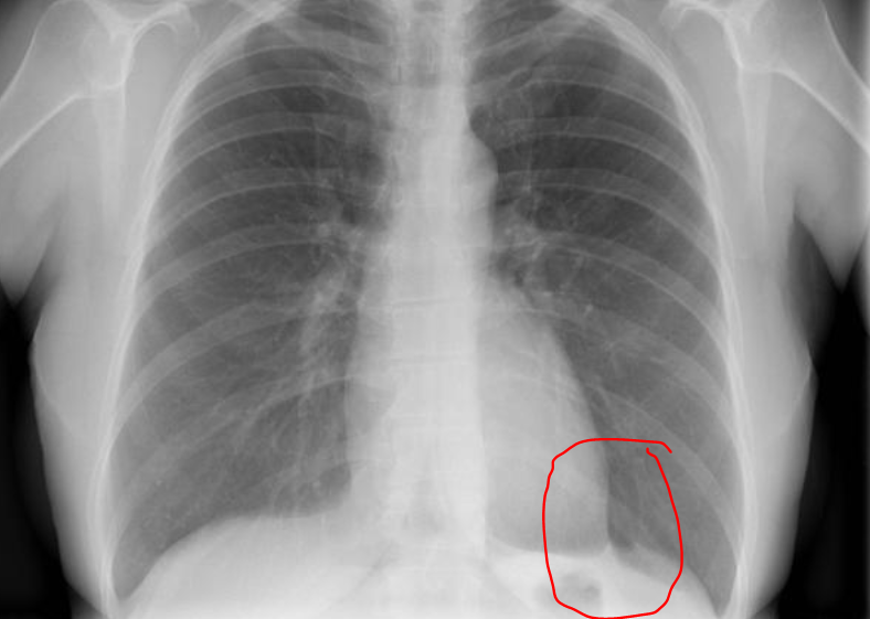 inferior pulmonary ligament radiopaedia.org
