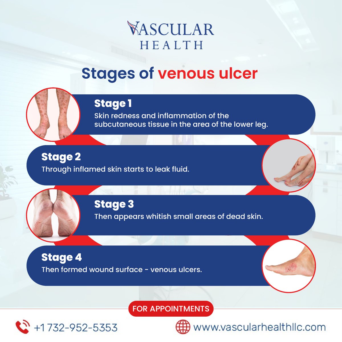 Venous ulcers are leg ulcers caused by problems with blood flow (circulation) in your leg veins. Here are the 4 stages of venous ulcer from redness at the start to wounds at the skin's surface.

Book an Appointment: vascularhealthllc.com/schedule/

#VascularHealth #VenousDisease #Veins