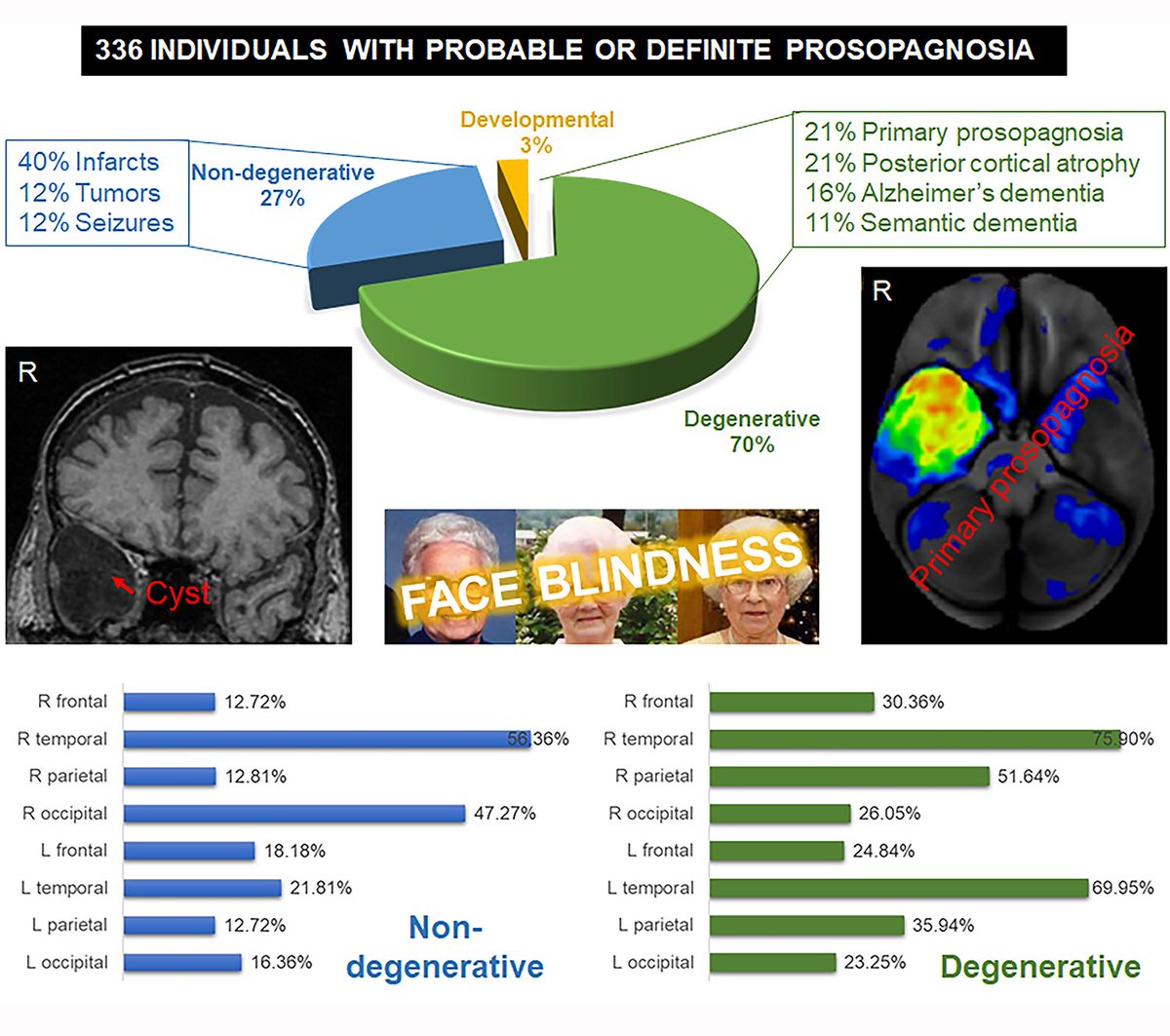 @BrainComms (@braincomms) on Twitter photo Josephs and Josephs report 336 patients diagnosed with #prosopagnosia over a 23-year period. <a href="/NRGmayo/">Neurodegenerative Research Group at Mayo Clinic</a> shorturl.at/abfmP Josephs and Josephs report 336 patients diagnosed with #prosopagnosia over a 23-year period. <a href="/NRGmayo/">Neurodegenerative Research Group at Mayo Clinic</a> shorturl.at/abfmP
