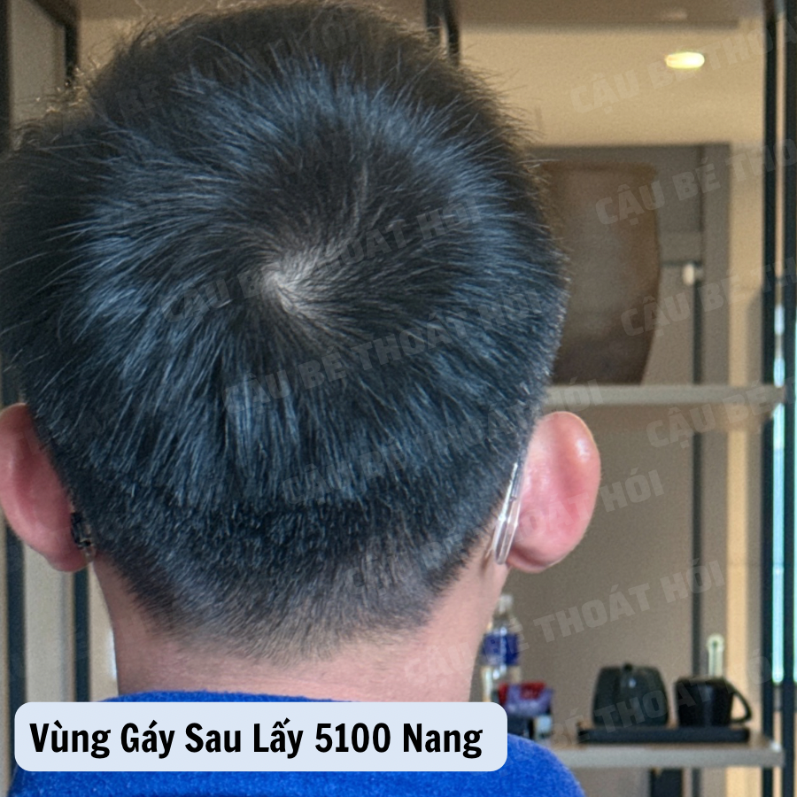 Ken76327503's tweet photo. Sau cấy tổng 5100 nang tóc tự thân bằng công nghệ DHI https://t.co/GlSWnOU47F