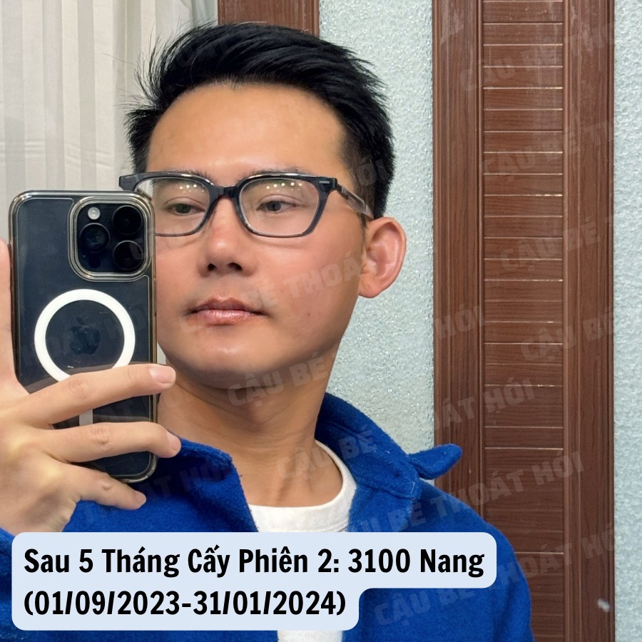 Ken76327503's tweet photo. Sau cấy tổng 5100 nang tóc tự thân bằng công nghệ DHI https://t.co/GlSWnOU47F