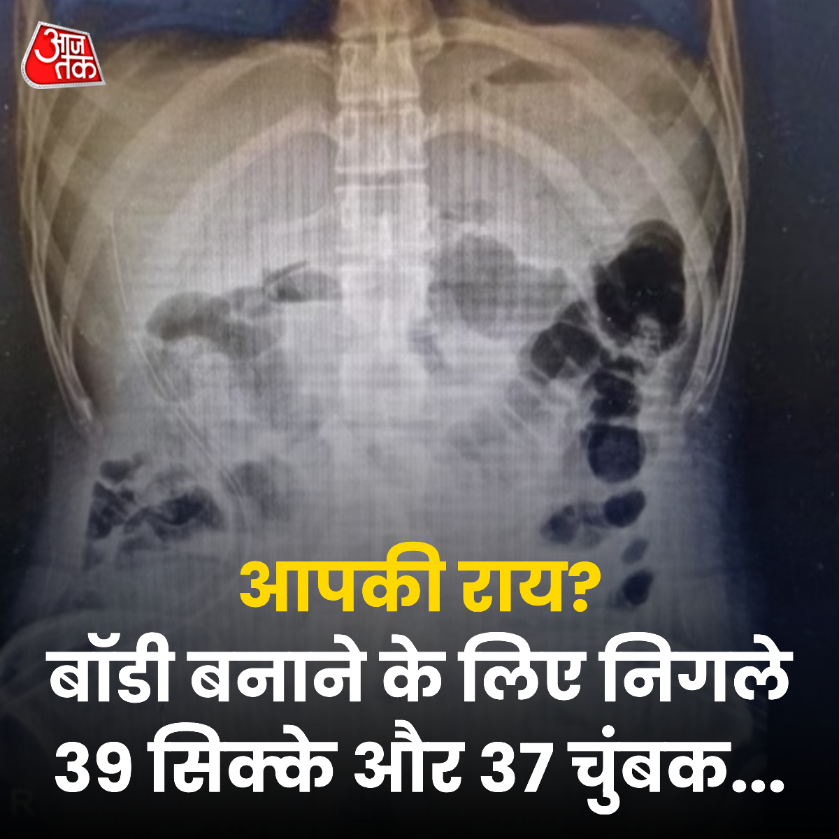 aajtak's tweet photo. दिल्ली के सर गंगाराम अस्पताल में 26 साल का युवा मरीज़ बार-बार उल्टी और पेट दर्द की परेशानी लेकर इमरजेंसी विंग में आया. वह कुछ भी खा नहीं पा रहा था. ओपीडी में सीनियर डॉक्टर डॉ. तरुण मित्तल ने उसकी जांच रिपोर्ट देखी तो दंग रह गए. क्योंकि मरीज़ की आंतों में 39 सिक्के और 37 चुंबक के टुकड़े मिले. हालांकि, डॉक्टरों ने सर्जरी कर मरीज़ की जान बचा ली.
पूरी खबर: https://t.co/kiOl1ibj9P
#Delhi #Health | @arvindojha