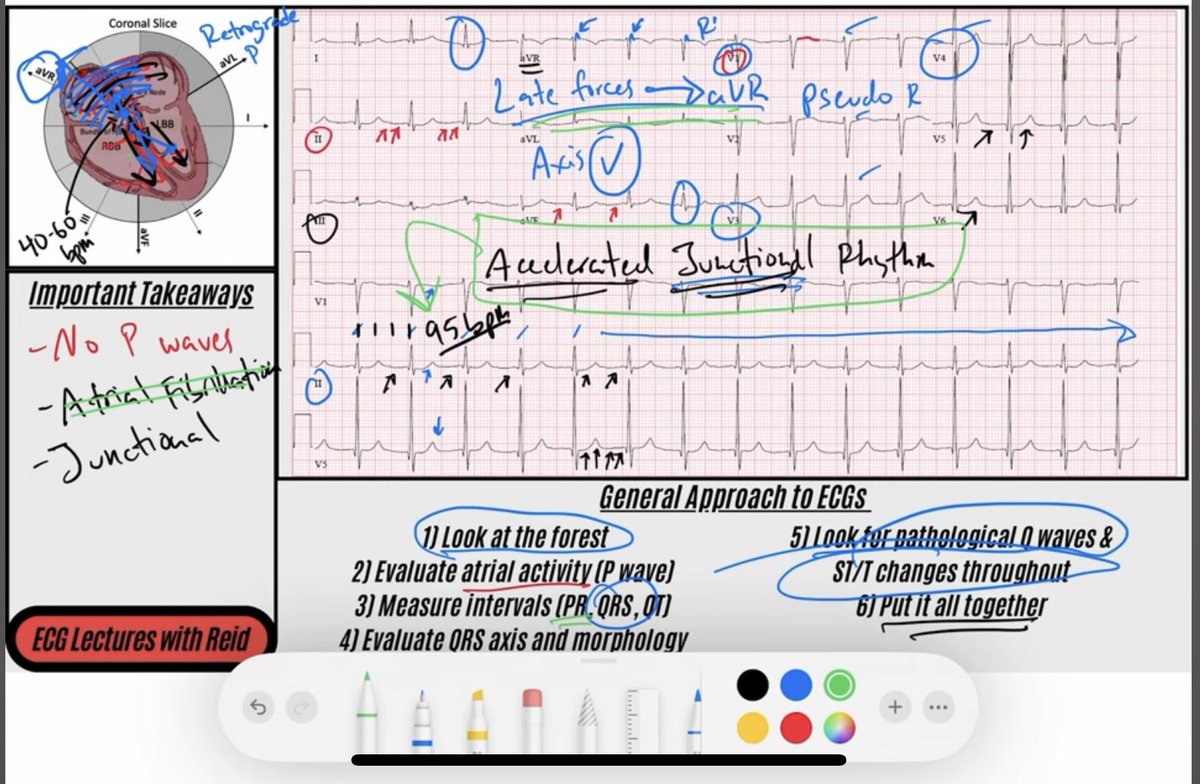 #ECG of the Day, Number 71! Was a fun case of Accelerated Junctional Rhythm ⬇️ youtu.be/7lpxGvfxeIw?si…