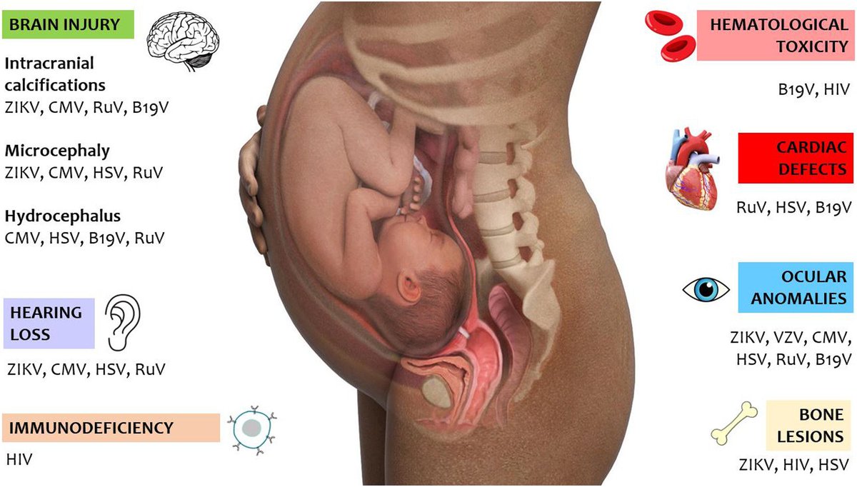 @Sthanu5 CT shows hydrocephalus w/ associated calcifications in the periventricular regions related to a suspected perinatal CMV infection. 

DDx:  perinatal ZIKV, RuV, B19V infections.

<Image source: @sciencedirect,   tinyurl.com/5n93ybm4>