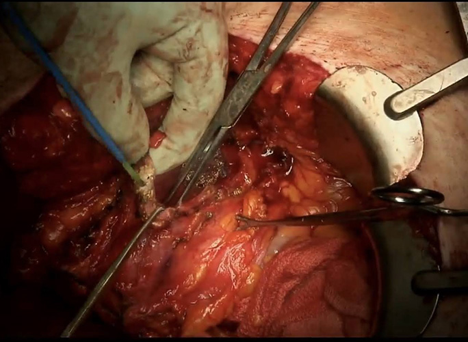 Newly modified ‘pseudo flap’ without compromising vascularity to enhance repair of long distal ureteral loss @merhan_badran #Boari_flap #ureteric_repair #ureter_reconstruction #ureteric_stricture #psoas_hitch #pseudo_flap doi.org/10.1002/bco2.3…