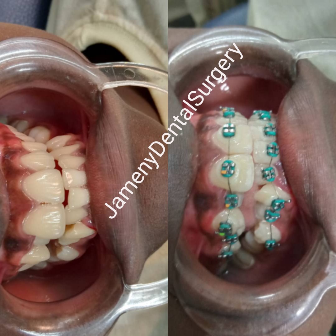 Turquoise Tuesday!!
Braces treatment started😊
Come get yours too at an affordable cost at our facility.😊
Contact 0778800815 for appointments. 

#TurquoiseTuesday
#bracestreatment
#JamenyDentalSurgery