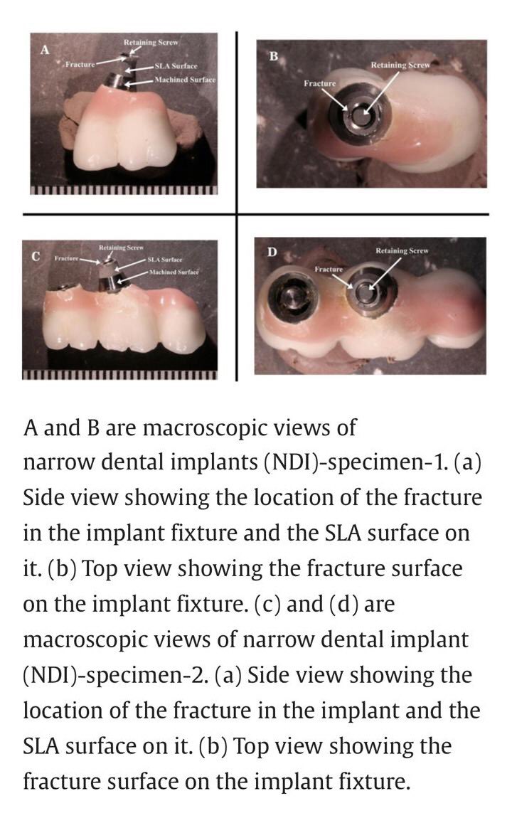 لكن و بشكل مختصر … زرعات Roxolid النحيلة من الممكن ان تفشل و تتكسر عن طريق الفشل الإجهادي (fatigue failure) في حالة وجود زيادة تحميل خارج محور الزرعة (off-axis loading).
و بالطبع من الصعوبة الخروج باستنتاج قطعي من حالة مرضية واحدة و عينتين بحثية فقط.