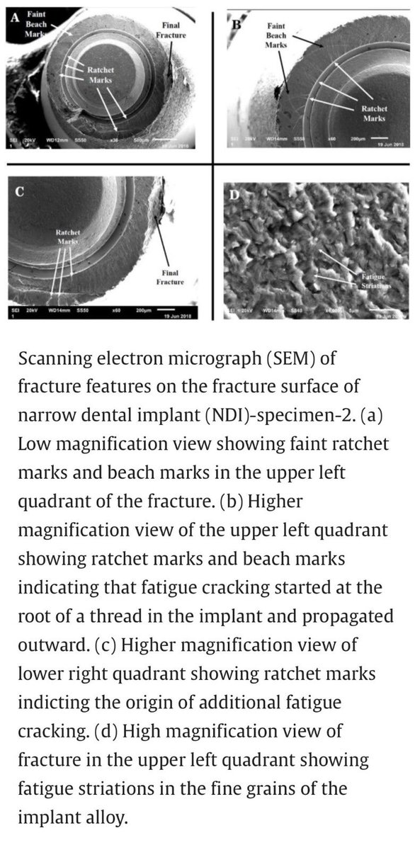 لكن تضل نتائج الدراسة و وتوصيتها المبدئية هو عدم تعريض الزرعات النحيلة لأحمال زائدة خارج المحور و المتمثلة مثلاً: ١) عدم عمل جسر معلق(cantilever) و ٢) الاهتمام بالتطابق مع الاسنان المقابلة خلال الاطباق وعدم وجود احمال خارج المحور خلال حركات الفم السُيُوحِيّة(excursive movements).