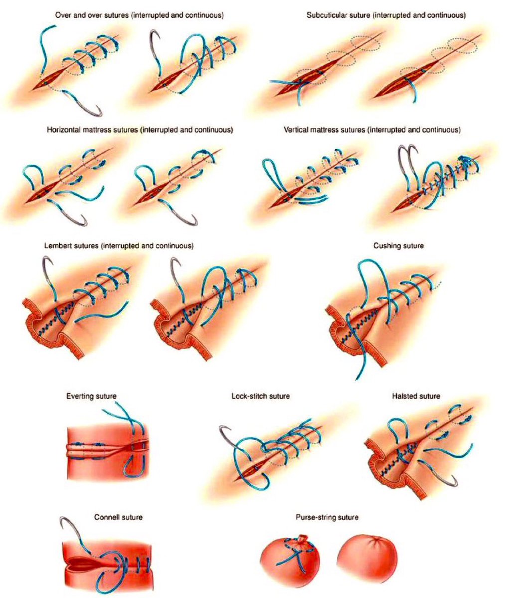 Surgical Suture Types 
#MedEd #MedTwitter #FOAMed #MedX #suture