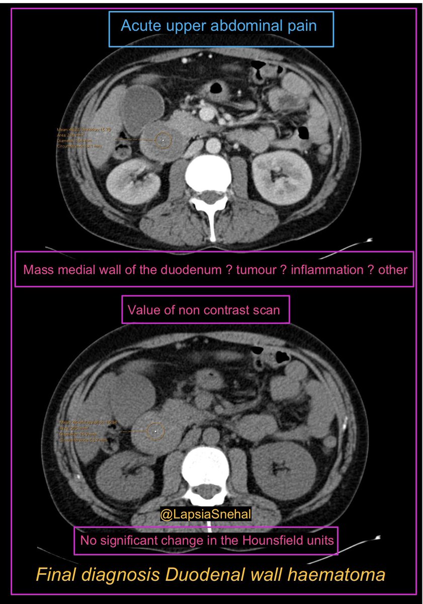 Non contrast imaging is your friend !!

#FOAMrad #FOAMed #meded  #radres #futureradres #medstudenttwitter #gitwitter #anatomy #frcr #surgery #radiology #radtwitter #medtwitter