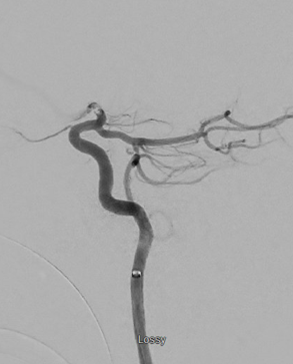 It's always important to understand #anatomy even during an #ICA terminus occlusion - how would you classify this pcomm artery? Comment below!
#stroke <a href="/cvsection/">CV Section</a> <a href="/esmintsociety/">ESMINT Society</a>