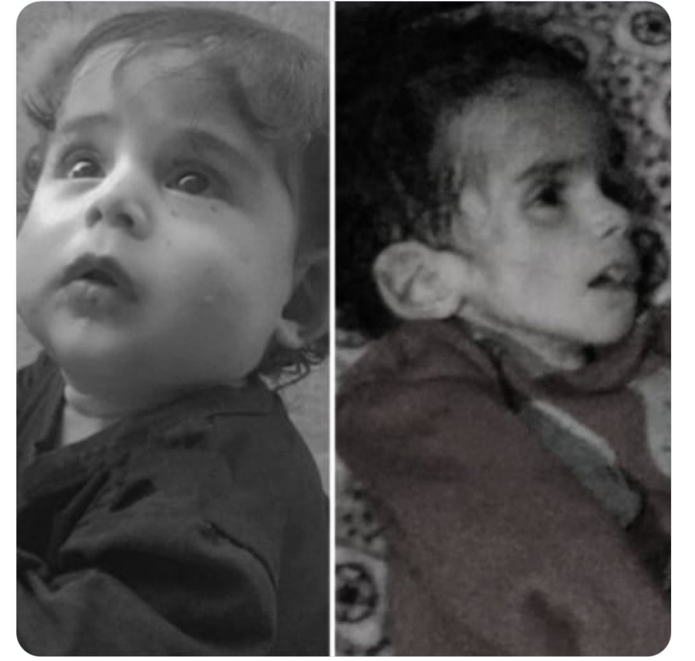 A new victim of the famine in Gaza. Picture of the girl “Anhar Al-Shanbari” before the war and after the famine, she died yesterday due to hunger. Don't look away.